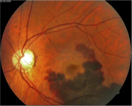 Exame de imagem para constatação da DMRI. Nesta imagem é possível constatar a DMRI Úmida ou exsudativa, a forma mais grave da doença. É possível ver a formação de vasos anormais embaixo da retina. Exame de imagem para constatação da DMRI. Nesta imagem é possível constatar a DMRI Úmida ou exsudativa, a forma mais grave da doença. É possível ver a formação de vasos anormais embaixo da retina.